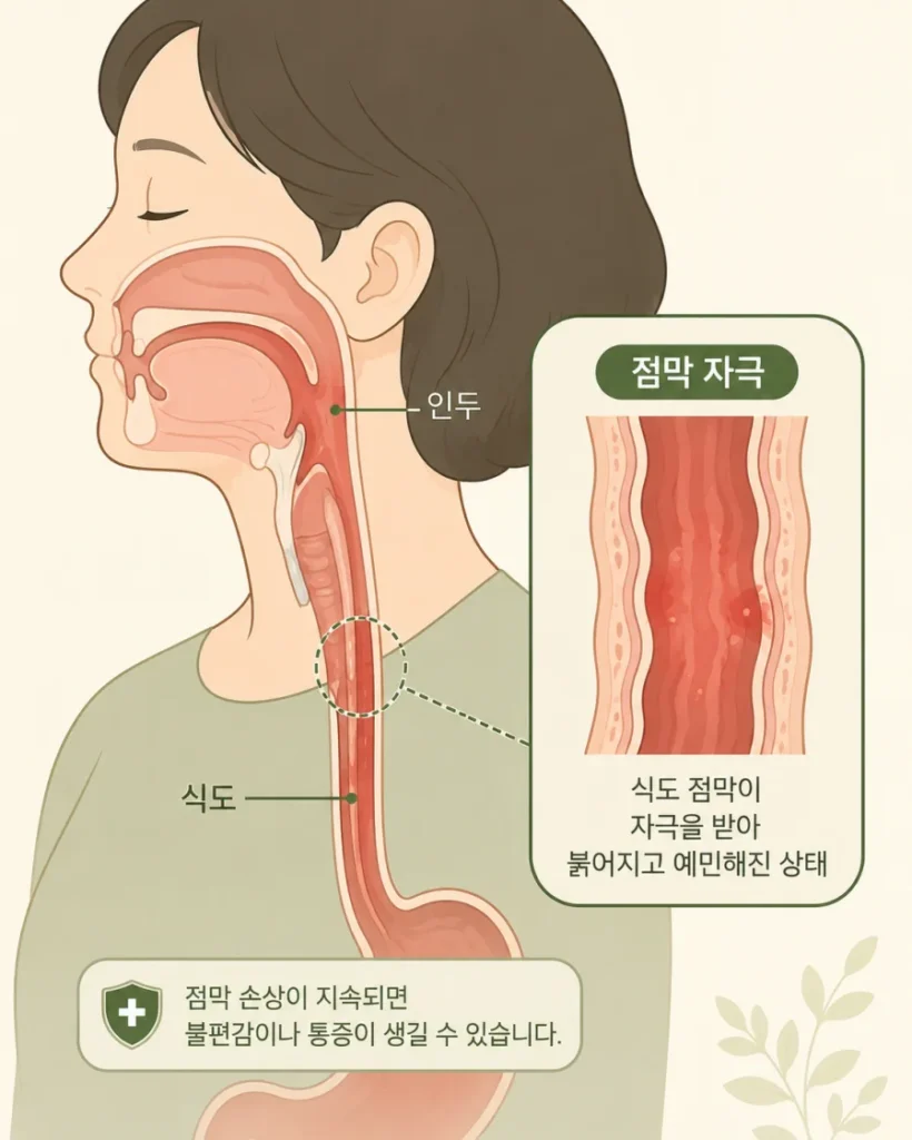 식도 점막 자극 원리를 보여주는 의학 일러스트