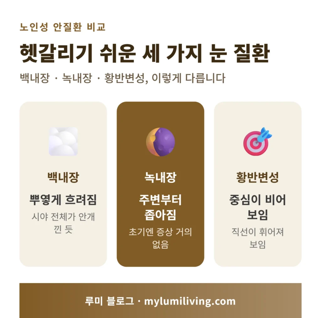 백내장 녹내장 황반변성 증상 비교 인포그래픽