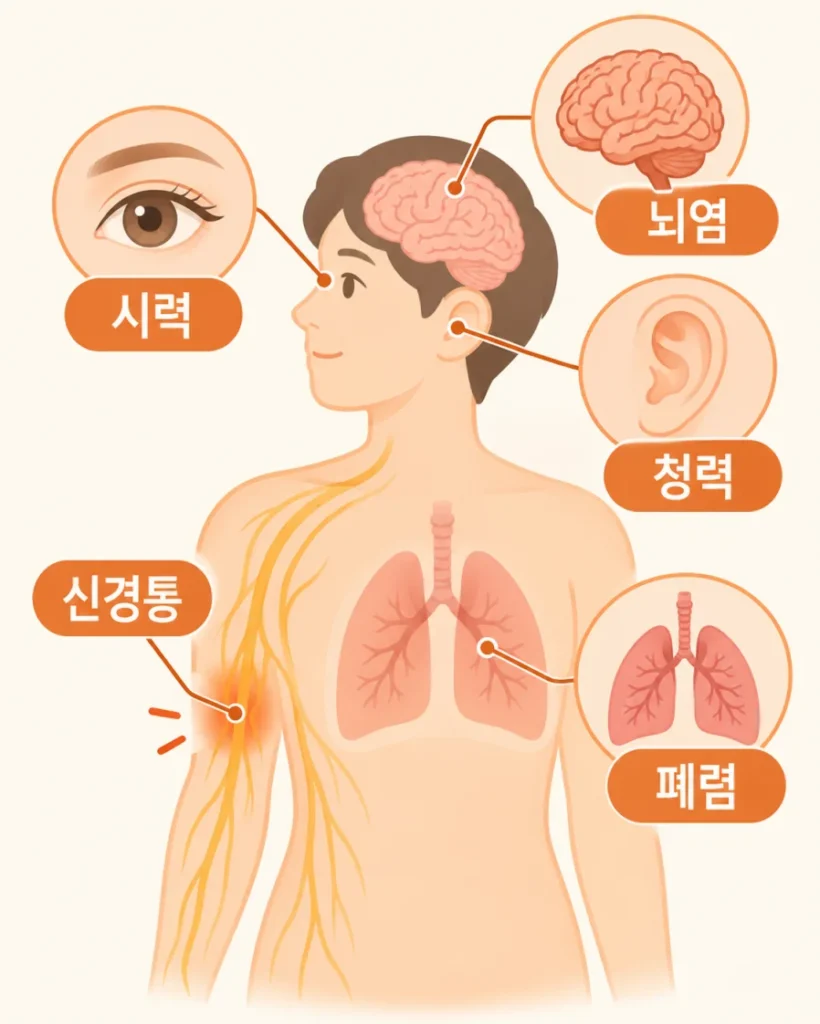 대상포진 합병증 부위를 한글로 표시한 의학 일러스트