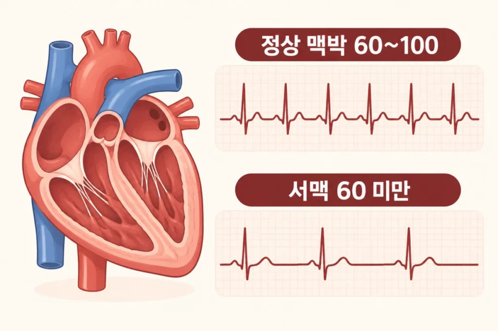 정상 심박과 서맥 파형을 비교한 의학 일러스트