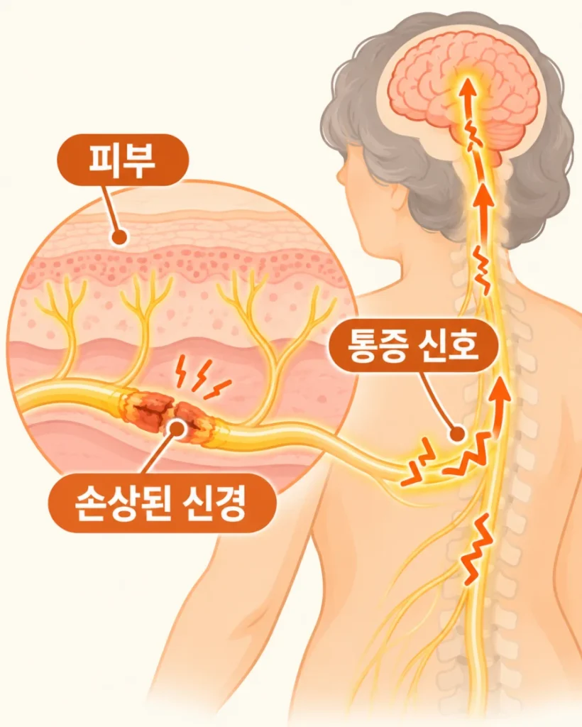 대상포진 후 신경통 통증 신호 전달을 한글로 표시한 의학 일러스트
