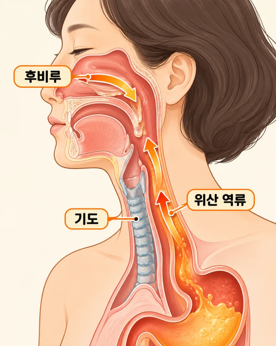 후비루와 위산 역류가 기도를 자극하는 경로를 보여주는 의학 일러스트